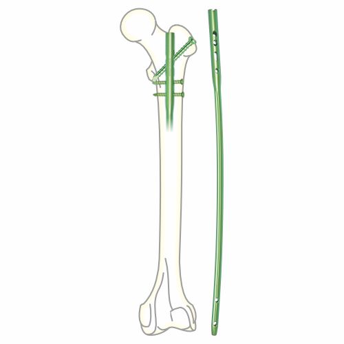 Femur-Interlocking-Nail