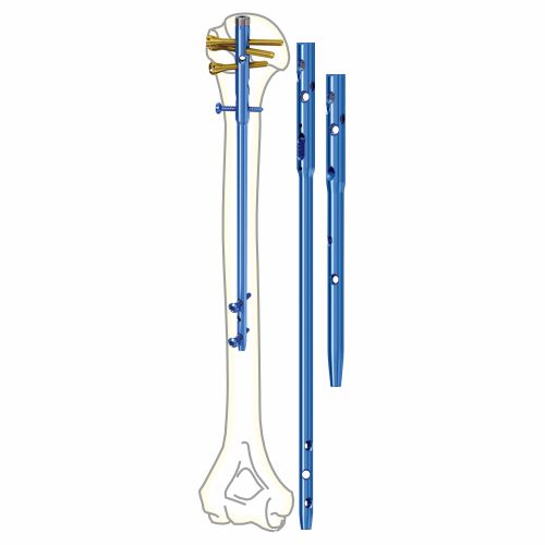 MULTI LOCK Humerus Interlocking Nail