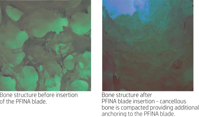 Proximal Femoral Nail Antirotation Blade