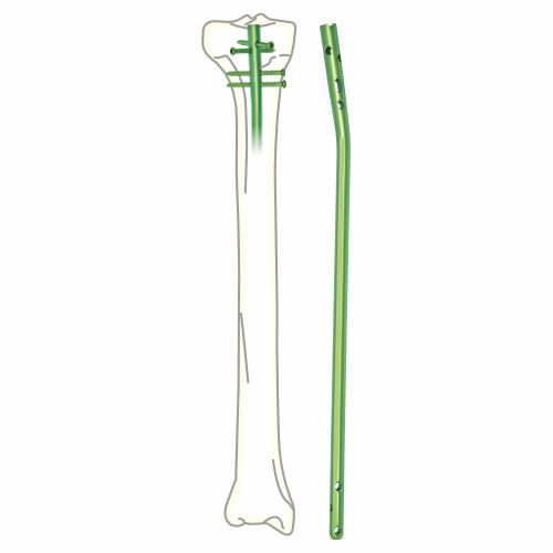 Tibia-Interlocking-Nail