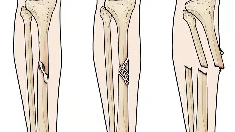Tibial Shaft Fractures: Overview, Anatomy & Key Signs