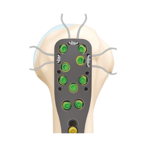 Peripheral_Suture_Holes | AOSYS PVT LTD