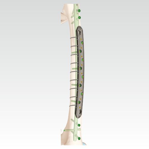 VA Locking Cable Plate, Broad | AOSYS PVT LTD