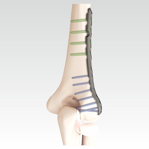 VA Locking Distal Humerus Plate, Lateral | AOSYS PVT LTD