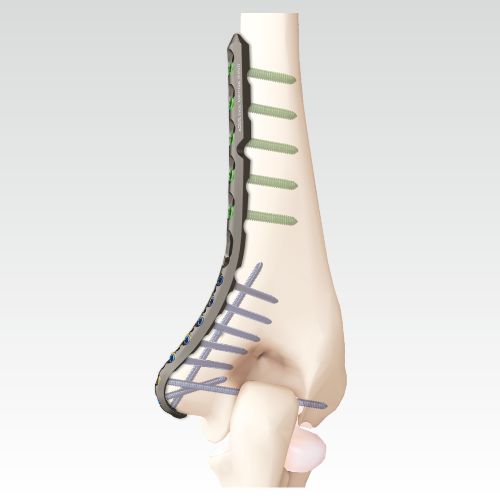 VA Locking Extended Medial Distal Humerus Plate