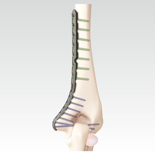 VA Locking Medial Distal Humerus Plate