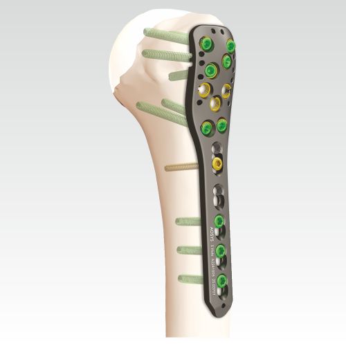 VA-Locking-Proximal-Humerus-Plate