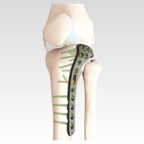 VA Locking Proximal Tibial Plate | AOSYS PVT LTD