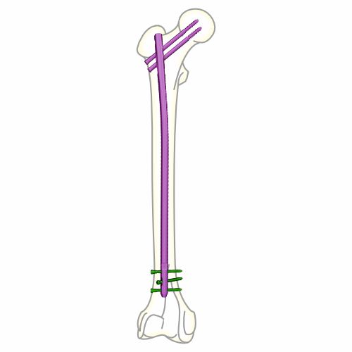 Advance-Femur-Nail-GT