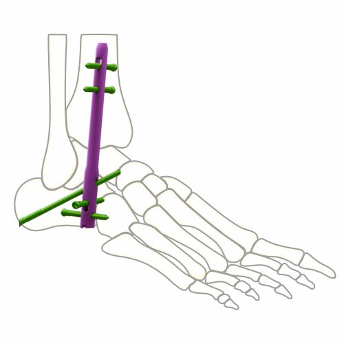 Ankle Fusion Nail
