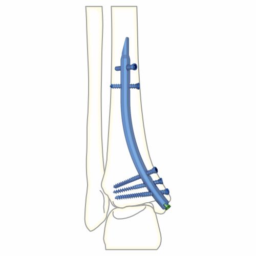 Distal Tibial Nail