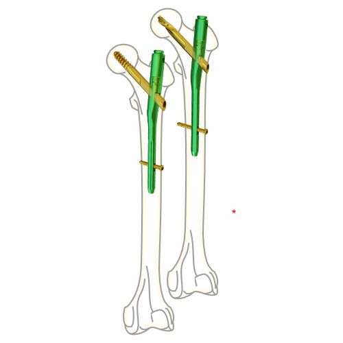 TFA Interlocking Nail