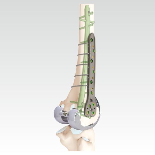 VA Locking Curved Condylar Cable Plate | AOSYS PVT LTD